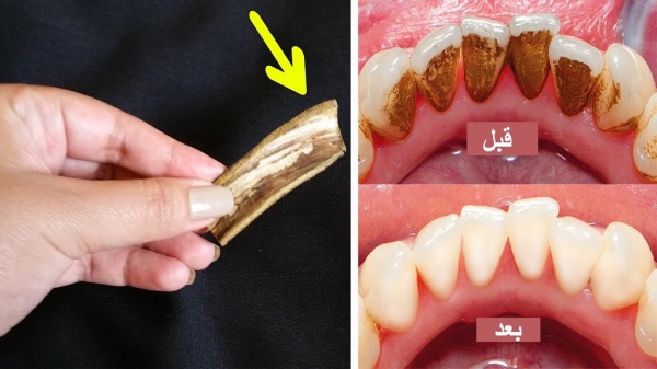 اذا كنت تشعر بالخجل من اسنانك الصفراء .. طرق طبيعية لها نفس الأثر الطبي لأسنان بيضاء وجميلة!